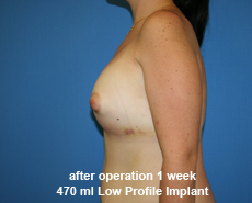 plastic-surgery-breast-augmentation